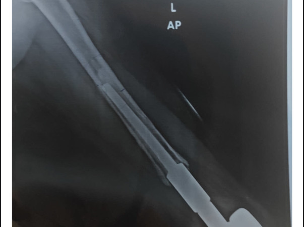 Support Pratik’s Urgent Knee Implant Surgery