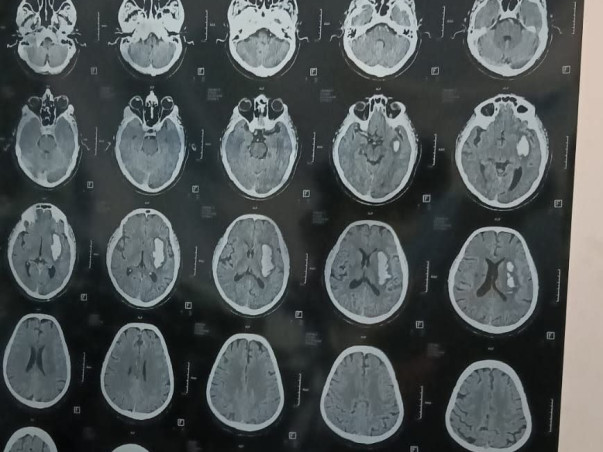 Help My Father Fight Critical Brain Stroke Treatment.
