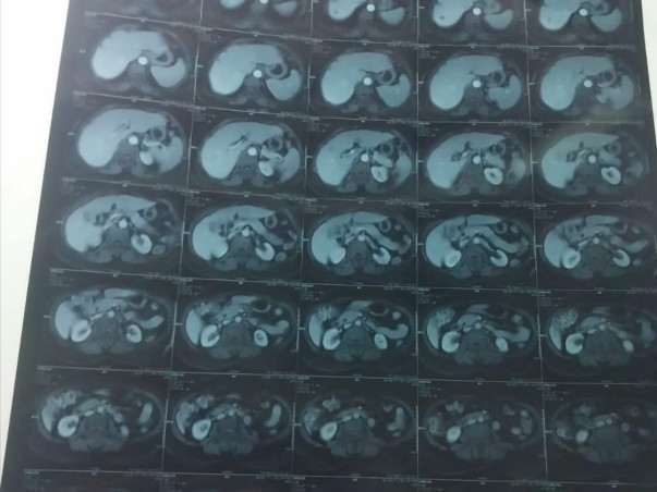 My sister Sanjida, [49], has Gall Bladder Cancer. Her treatment is on.