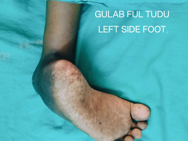 Help Gulab Ful Tudu Walk Again: A Journey from Despair to Hope