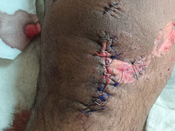 Help Vishal recover from accident & spine injury 🙏