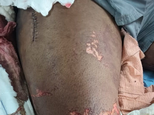 Help Vishal recover from accident & spine injury 🙏