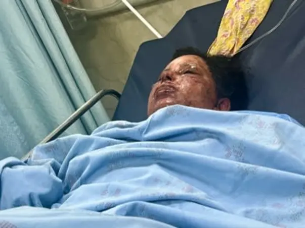 Help Lakshmi recover from severe burns after a tragic accident