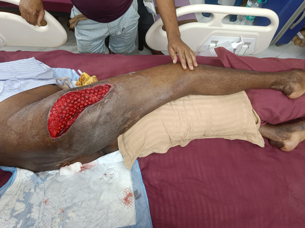 Support Tuhin (a budding scientist) to recover from a truck accident and able to walk again.