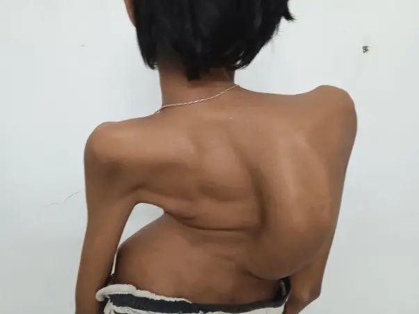 Help save my sister Prithajanet from life-threatening scoliosis