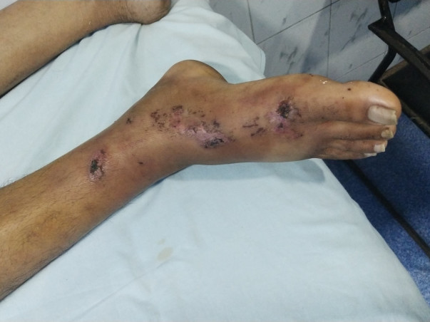 Help my father recover from a severe leg fracture urgently