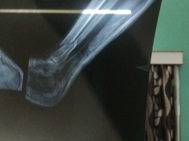 Help my father recover from a severe leg fracture urgently