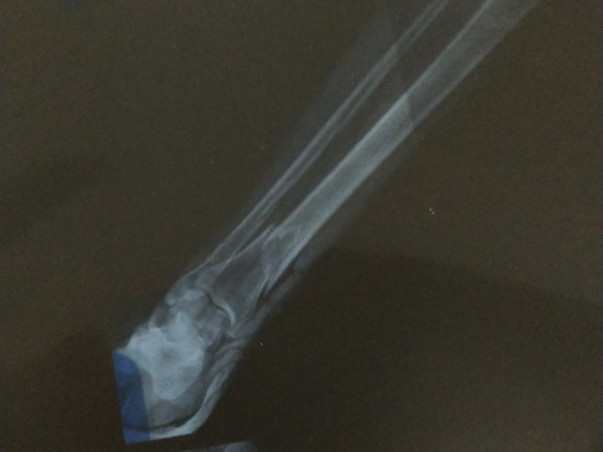 Help my father recover from a severe leg fracture urgently