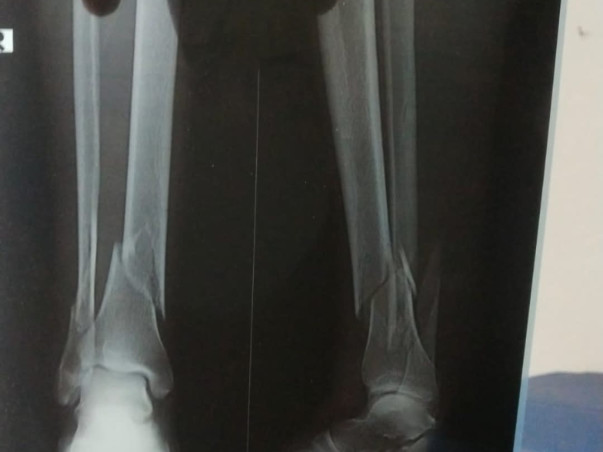 Help my father recover from a severe leg fracture urgently
