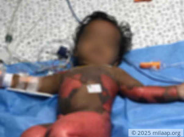 65% Of This Baby’s Body Is Burnt And He’s Struggling To Live