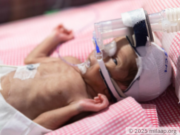 After Losing One Twin, Poor Father Struggles To Save The Other