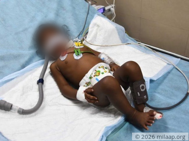 Help 11-month-old Kabelish Fight Pneumonia And Breathe Again