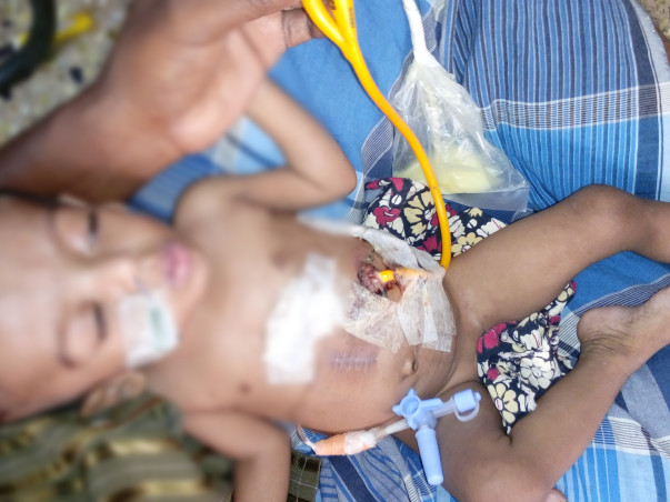 This Baby requires a surgery so that he can eat through his mouth