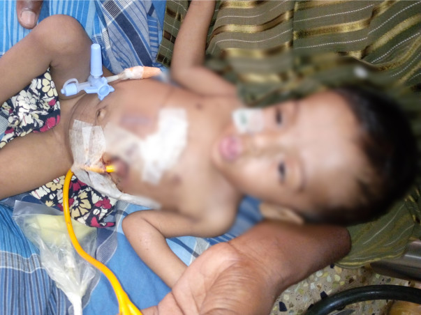 This Baby requires a surgery so that he can eat through his mouth