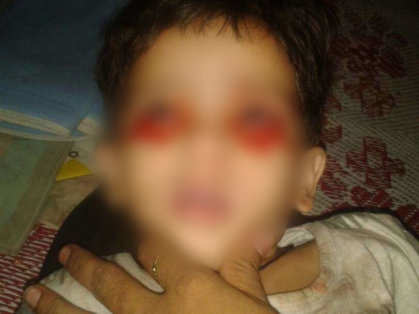 4-Year-Old Who Sweats Blood All Over Her Body Needs Urgent Help