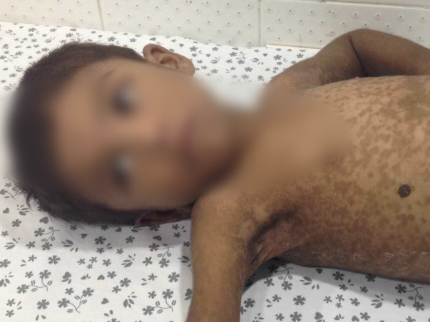 Help This 5-year-old With A Liver Abscess Who Is Screaming In Pain