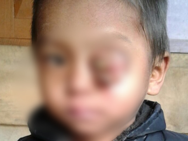 Baby Keffrien's Eye Has Been Ravaged By Cancer, Save His Life