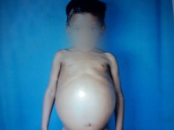 Help Joseph Raj From Gaucher Disease