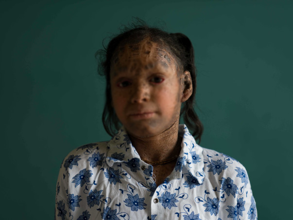 Help this 13-year-old girl fight a life of skin infections