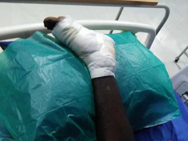 Help My Brother Undergo Liver Transplant after curing the leg infectio