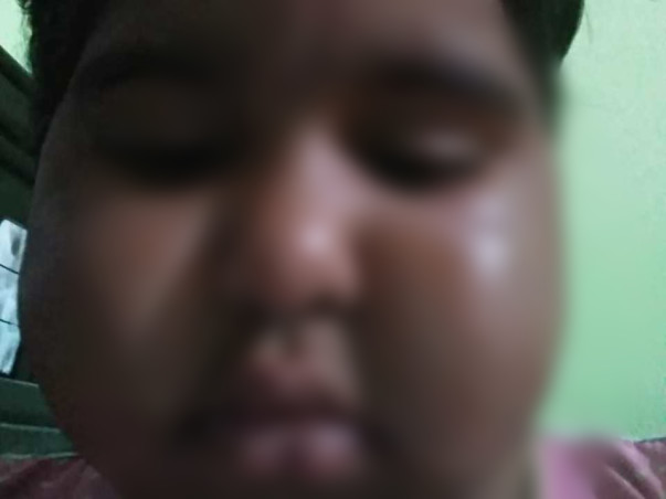 Help my Daughter  Srikruthi survive MOG Neurology disease