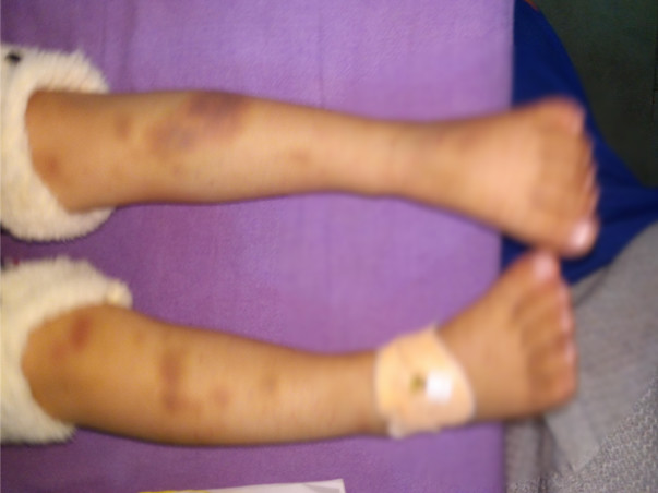 Help cute baby Recover From Idiopathic Thrombocytopenic Purpura