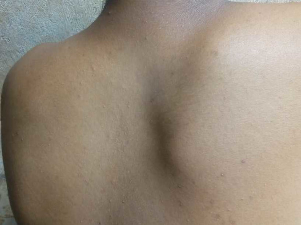 Detethering and dorsal scoliotic deformity correction