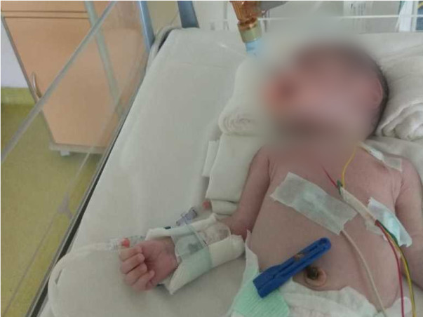 Help 18 Days Old Arjun Fight Nonketotic Hyperglycinemia
