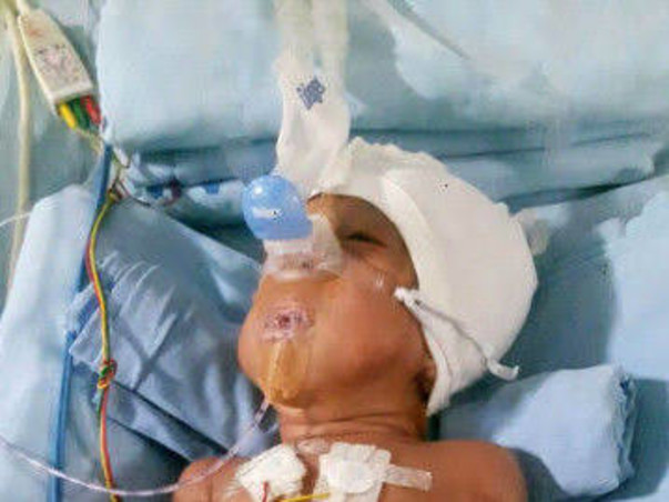 1 year old Diya needs your help for Liver transplant