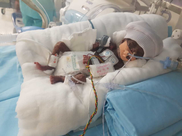 Help Baby Of Sowjanya To Survive