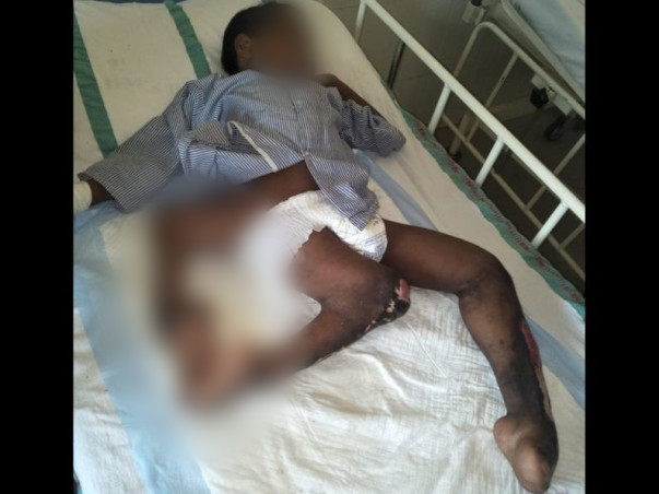 Help 11 Years Old Indian Boy Born With An Extra Leg Undergo Surgery