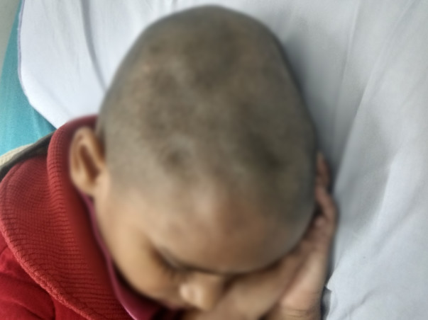 8 Years Old Haana Needs Your Help Fight Bone Damage On Forehead