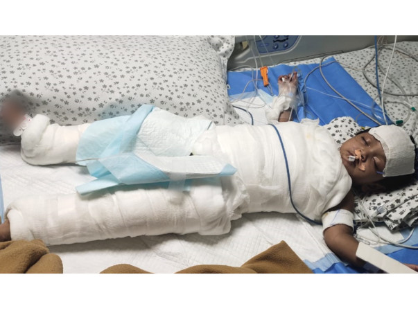 Support Anaya Mehiwish  Recover From Burn Injury 80 %