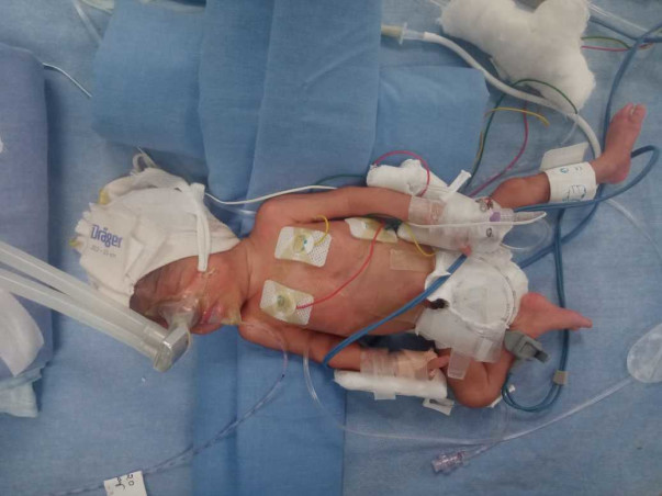 This 7 Days Old Needs Your Urgent Support In Preterm Twins