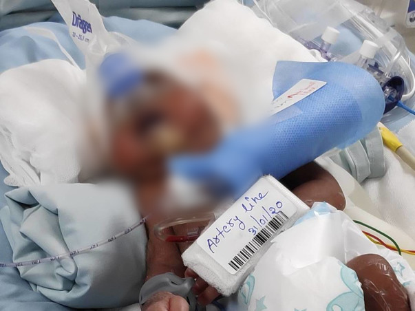 Help New Born Baby To Recover From Respiratory Distress Syndrome