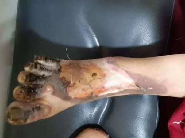 13 Years Old Rida Needs Your Help To Recover From Severe Electric Burn