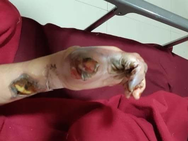 13 Years Old Rida Needs Your Help To Recover From Severe Electric Burn