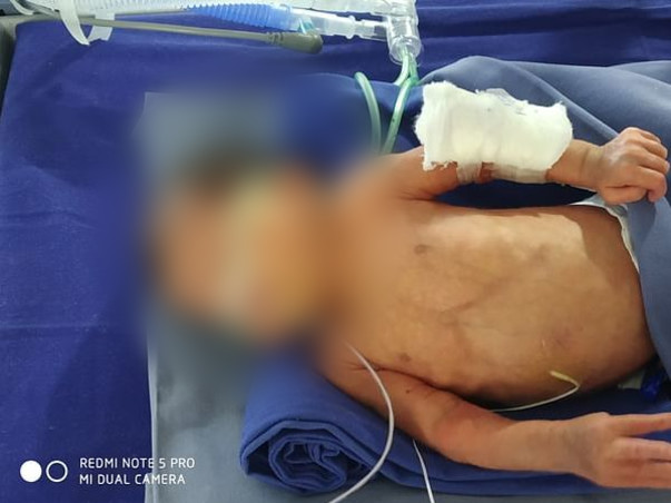 "Baby of Heena"has gone through multiple interstine surgeries,Help Her