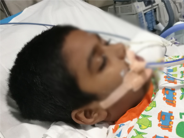 My 10 Years Old Son Is Struggling With Guillain-barré Syndrome, Help Him