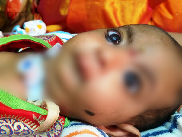 10 months old Aushi needs your help fight Maxillofacial surgery