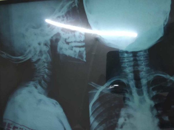 10 Yrs old Child need help for Brain Surgery