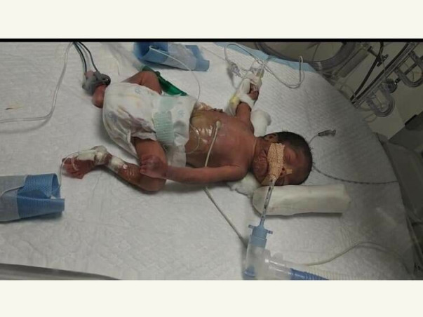 My One And Half Months Daughter Is Struggling With Preterm Issues, Please Help Her