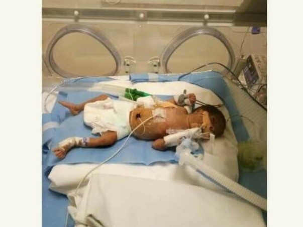 My One And Half Months Daughter Is Struggling With Preterm Issues, Please Help Her
