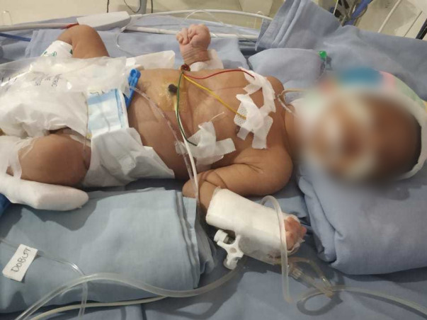 Help my 11-days-old son needs your help fight Terma/Aga, Respiratory Distress, Birth Asphyxia