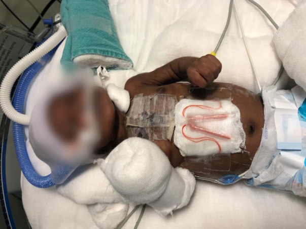 2-Month-Old With Heart Disease Needs ICU Care To Survive