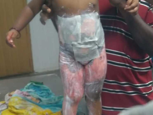 Please Help My Nephew from Severe Burn