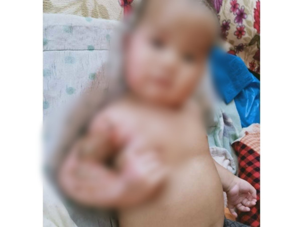 Support Baby Of Sumarlang Dkhar Recover From Severe Burns