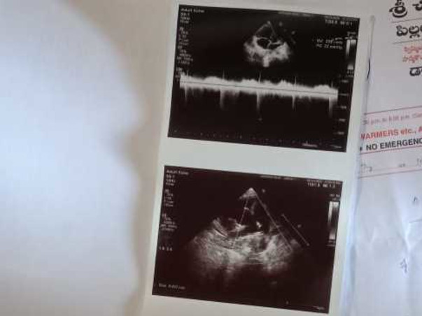 Help My Sister Fight Atrial Septal Defect