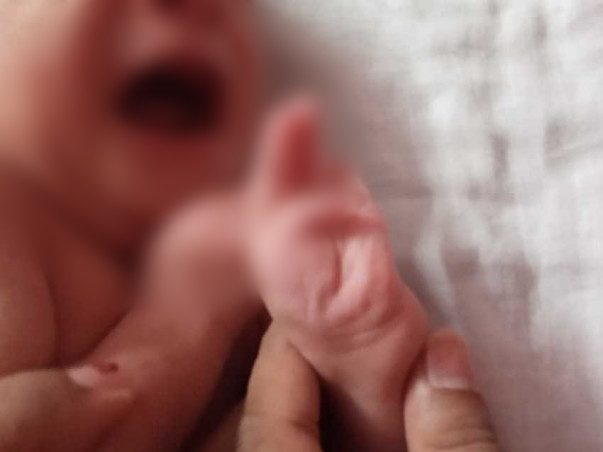 1 month old Aahan Needs Your Help Fight Arthrogryposis Multiplex Congenita