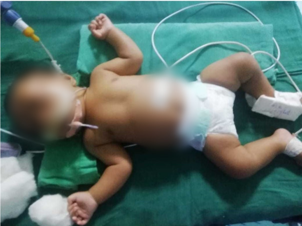 3 Months Old Sai Pradhan Needs Your Help To Recover From Congenital Heart Disease